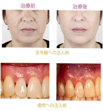 ヒアルロン酸治療例