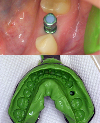 （STEP8）上部構造印象採得（型採り）