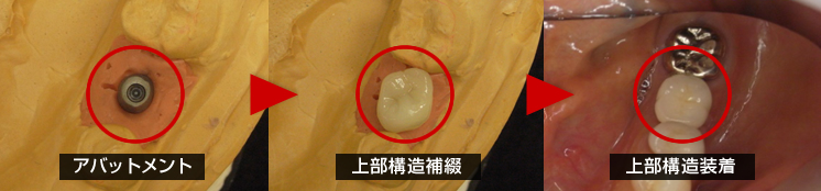 （STEP8）上部構造印象採得（型採り）